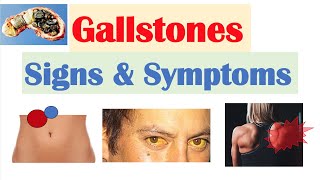 Gallstones Signs amp Symptoms Why They Occur  Cholecystitis Choledocholithiasis Cholangitis [upl. by Adlihtam365]