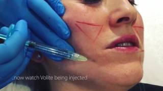 Volite InjectionsSkinboosters [upl. by Alta]