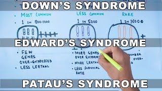 Trisomy  Downs vs Edwards vs Pataus Syndrome [upl. by Balsam]