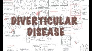 Diverticular Disease diverticulitis  Overview [upl. by Fish735]