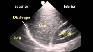 How To Ultrasound Detection of Pleural Fluid Case Study Video [upl. by Aronson83]