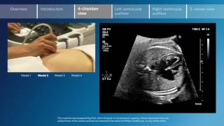 Key screening views of the fetal heart  Part 3  4chamber view [upl. by Sigmund604]