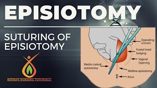 Episiotomy  Types Articles  Procedure ritikasnursingtutorials [upl. by Hendrika]