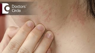 How to identify scabies rash amp its management  Dr Sudheendra Udbalker [upl. by Rudwik550]