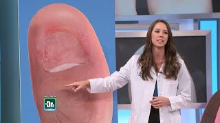 What To Do if Your Toenail Falls Off [upl. by Peggy]