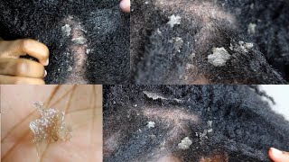 My Seborrheic Dermatitis my scalp up close [upl. by Hgierb984]