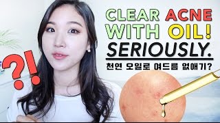 CLEAR ACNE WITH OIL • BEST Oils for Acne Prone Skin [upl. by Pryor]