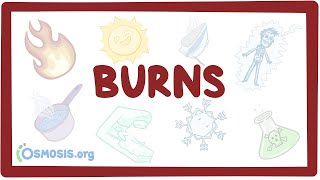 Burns  an Osmosis Preview [upl. by Eatnad]