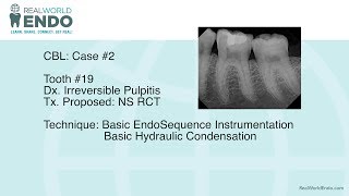 CBL 2 Basic Molar Root Canal Therapy 19 by RealWorldEndo [upl. by Imij]