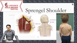 Sprengel Shoulder [upl. by Ingaberg697]