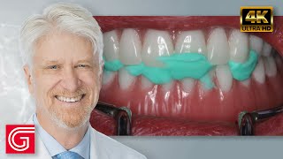 Restoration of Implant Overdentures by Timothy Kosinski DDS MAGD [upl. by Amles377]