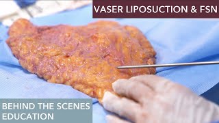 The Science Behind Vaser Liposuction How Does It Work [upl. by Hennessy]