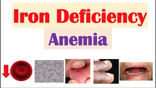 IronDeficiency Anemia Overview  Causes Pathophysiology Signs amp Symptoms Diagnosis Treatment [upl. by Augustus]