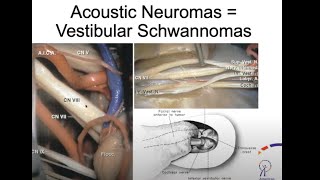 A Rare Brain Tumor Affecting Hearing amp Balance  Acoustic Neuroma [upl. by Ardeid940]