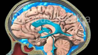 CSF leakage  Neuroanatomy [upl. by Benito]