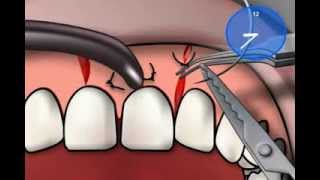 Vicryl Suture Material [upl. by Liartnod]