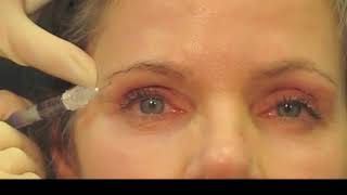 Filler Technique for Rejuvenation of the Upper Periocular Area [upl. by Kaylil699]