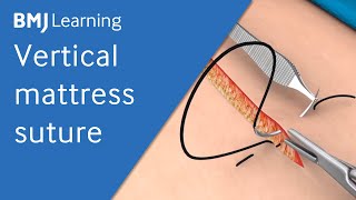 Vertical Mattress Suture  BMJ Learning [upl. by Zephan625]