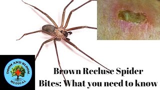 Brown Recluse Spider Bites What you need to know [upl. by Alaek]