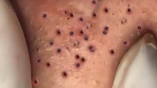 How To Remove Blackheads And Whiteheads On Face Easy 108 ✦ Dr Laelia ✦ [upl. by Orlena655]