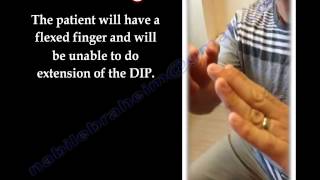 Boutonniere Deformity  Everything You Need To Know  Dr Nabil Ebraheim [upl. by Sucirdor]