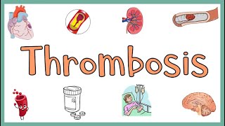 Thrombosis  Definition Causes Types Morphology Fate of a Thrombus amp Clinical manifestations [upl. by Martinsen]