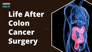 Life After Colon Cancer Surgery [upl. by Irahc]