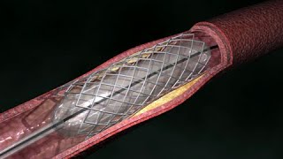 Coronary Artery Angioplasty  Radial Access [upl. by Atinaw]