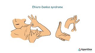 Hypermobile Ehlers Danlos SyndromeMy Story [upl. by Kunin569]