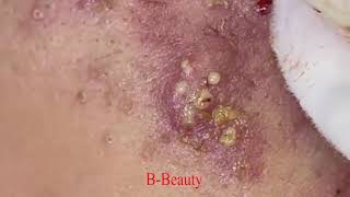 Pimple Removal and Acnes Treatment  BBeauty 07 [upl. by Oira]