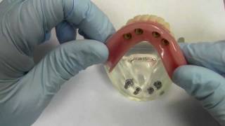 4Implant Ball Attachment Overdenture  Model Demonstration [upl. by Burris]