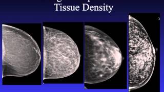 Introduction to Mammography [upl. by Eetnom]