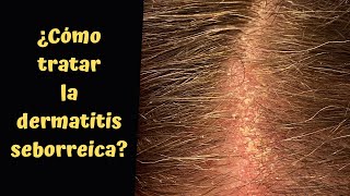 ¿CÓMO TRATAR LA DERMATITIS SEBORREICA [upl. by Doxia]