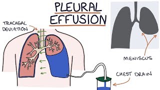 Understanding Pleural Effusions [upl. by Aihsenot]