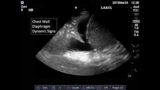 Lung and Pleural Ultrasound Interpretation [upl. by Gilead516]