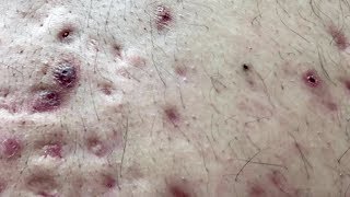 How To Remove Blackheads And Whiteheads On Back ✦ Dr Laelia ✦ [upl. by Philipp]