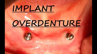 Implant Overdenture Planning  Part 1 Implant Supported Overdenture  Step by Step Planning [upl. by Aelsel]