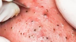 How To Remove Blackheads And Whiteheads On Face Easy 105 ✦ Dr Laelia ✦ [upl. by Sidnarb6]