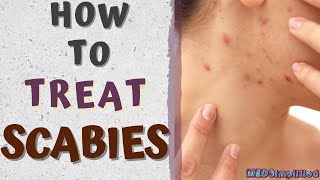 HOW TO TREAT SCABIESscabies treatment at home [upl. by Audre]