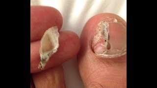 Toenail Torn Off Try This [upl. by Aihceyt630]