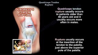 Quadriceps Tendon Rupture  Everything You Need To Know  Dr Nabil Ebraheim [upl. by Dnumsed43]