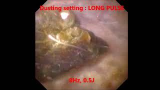 Laser Lithotripsy  Laser Kidney Stones  Setting Demonstration  Sydney NSW [upl. by Nila]