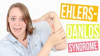 042 EhlersDanlos Syndrome EDS and Hypermobility [upl. by Oneil]