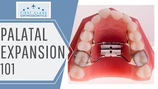 FIRST CLASS ORTHODONTICS  Palatal Expander 101 [upl. by Alraep30]