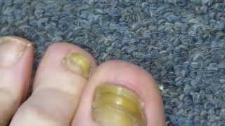 My Toenail Fungus Sucess Story [upl. by Anikes107]