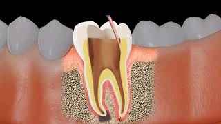 Root canal treatment RCT Procedure animation [upl. by Elrae716]