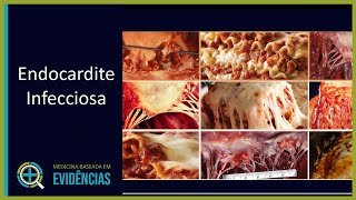 Endocardite Infecciosa  Aula [upl. by Galliett195]