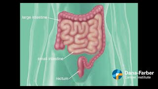 Colorectal Cancer in young adults A patients story [upl. by Hilel]