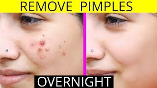 How To Remove Pimples Overnight  Acne Treatment  Anaysa [upl. by Brockwell]