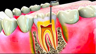 Understanding Root Canal Therapy [upl. by Arda]